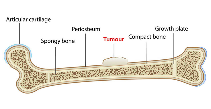 Bone sarcoma