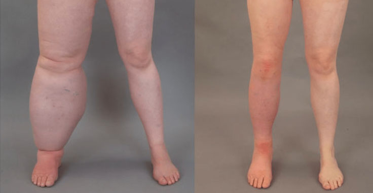 Lymphedema Surgery